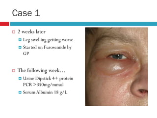Case 1
 2 weeks later
 Leg swelling getting worse
 Started on Furosemide by
GP
 The following week…
 Urine Dipstick 4+ protein
PCR >350mg/mmol
 SerumAlbumin 18 g/L
 