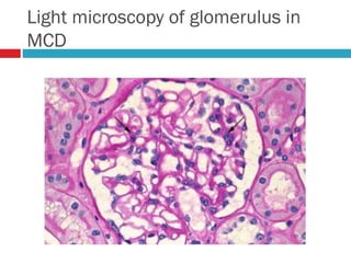 Light microscopy of glomerulus in
MCD
 