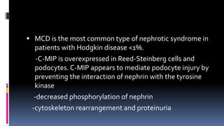  MCD is the most common type of nephrotic syndrome in
patients with Hodgkin disease <1%.
-C-MIP is overexpressed in Reed-Steinberg cells and
podocytes. C-MIP appears to mediate podocyte injury by
preventing the interaction of nephrin with the tyrosine
kinase
-decreased phosphorylation of nephrin
-cytoskeleton rearrangement and proteinuria
 