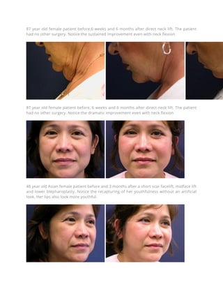Minimal Incision Facelift Surgery and Lower Face Lift Incisions | PDF
