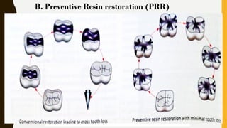 Prr Tooth MINIMAL INTERVENTION DENTISTRY as related to pediatric dentistry.pptx