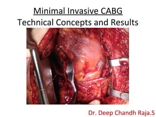 Minimal Invasive CABG
Technical Concepts and Results
Dr. Deep Chandh Raja.S
 