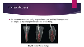 Incisal Access
 In contemporary access cavity preparation access is shifted from centre of
the lingual to incisal edge to increase the accessibility.
 