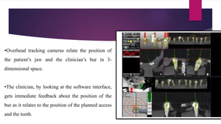 •Overhead tracking cameras relate the position of
the patient’s jaw and the clinician’s bur in 3-
dimensional space.
•The clinician, by looking at the software interface,
gets immediate feedback about the position of the
bur as it relates to the position of the planned access
and the tooth.
 