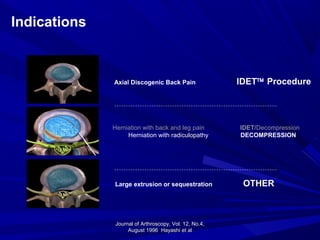 Journal of Arthroscopy, Vol. 12, No.4,Journal of Arthroscopy, Vol. 12, No.4,
August 1996 Hayashi et alAugust 1996 Hayashi et al
Indications
Herniation with back and leg pain IDET/Decompression
Herniation with radiculopathy DECOMPRESSION
Axial Discogenic Back Pain IDET™ Procedure
Large extrusion or sequestration OTHER
 