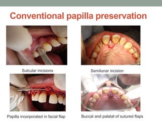 Conventional papilla preservation
Sulcular incisions Semilunar incision
Papilla incorporated in facial flap Buccal and palatal of sutured flaps
 