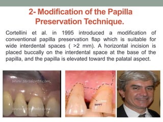 2- Modification of the Papilla
Preservation Technique.
Cortellini et al. in 1995 introduced a modification of
conventional papilla preservation flap which is suitable for
wide interdental spaces ( ˃2 mm). A horizontal incision is
placed buccally on the interdental space at the base of the
papilla, and the papilla is elevated toward the palatal aspect.
 