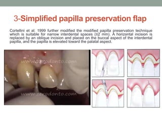 3-Simplified papilla preservation flap
Cortellini et al. 1999 further modified the modified papilla preservation technique
which is suitable for narrow interdental spaces (≤2 mm). A horizontal incision is
replaced by an oblique incision and placed on the buccal aspect of the interdental
papilla, and the papilla is elevated toward the palatal aspect.
 