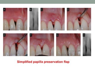 Simplified papilla preservation flap
 