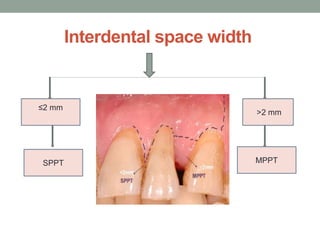 Interdental space width
≤2 mm
˃2 mm
SPPT MPPT
 