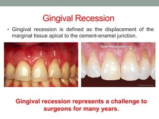  Gingival recession is defined as the displacement of the
marginal tissue apical to the cement-enamel junction.
Gingival Recession
Gingival recession represents a challenge to
surgeons for many years.
 
