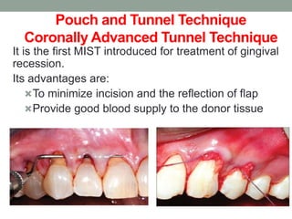 Pouch and Tunnel Technique
Coronally Advanced Tunnel Technique
It is the first MIST introduced for treatment of gingival
recession.
Its advantages are:
To minimize incision and the reflection of flap
Provide good blood supply to the donor tissue
 
