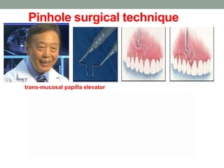 Pinhole surgical technique
trans-mucosal papilla elevator
 