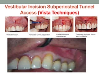 Vestibular Incision Subperiosteal Tunnel
Access (Vista Techniques)
Vertical incision Periosteal tunnel preparation Connective tissue
graft inserted
Coronally anchored suture
with composite
 