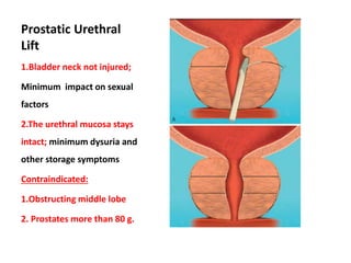 Minimally invasive and endoscopic management of benign prostatic | PPTX