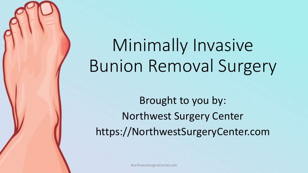 Minimally Invasive Bunion Removal Surgery