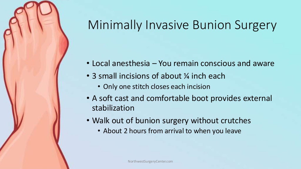 Minimally Invasive Bunion Removal Surgery