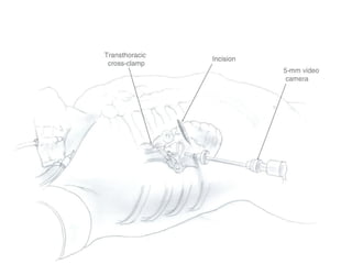 Minimally invasive cardiac surgery | PDF