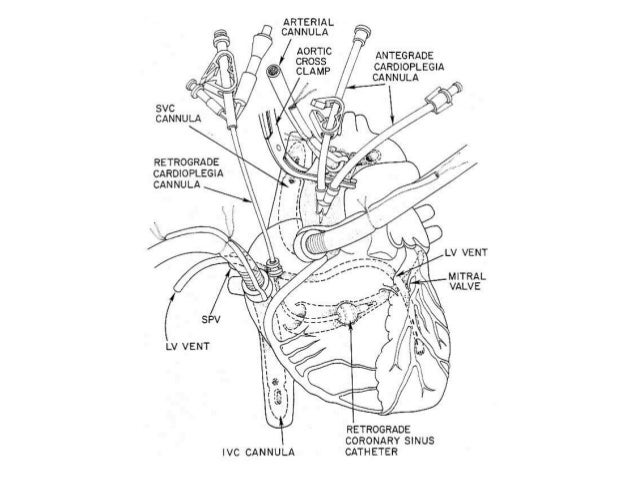 Minimally invasive cardiac surgery