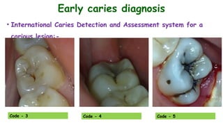Caries Code R1 Minimally Invasive Dentistry - Dr. Babel's Unique Dental Clinic, Pimple ...