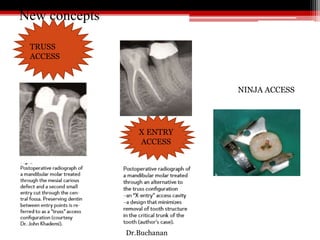 New concepts
TRUSS
ACCESS
NINJA ACCESS
X ENTRY
ACCESS
Dr.Buchanan
 