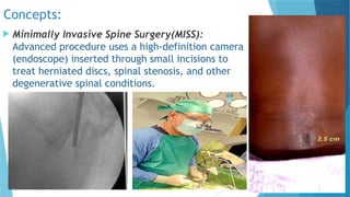Spine Incision Minimally Invasive Endoscopic Guided Spine Surgery Using Modified ...