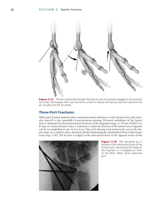Minimally Invasive Orthopaedic Trauma.pdf