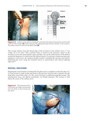 Minimally Invasive Orthopaedic Trauma.pdf