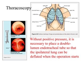 Thoracoscopy 
Without positive pressure, it is 
necessary to place a double-lumen 
endotracheal tube so that 
the ipsilateral lung can be 
deflated when the operation starts 
 