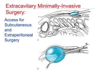 Extracavitary Minimally-Invasive 
Surgery: 
Access for 
Subcutaneous 
and 
Extraperitoneal 
Surgery 
 
