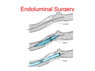Endoluminal Surgery 
 