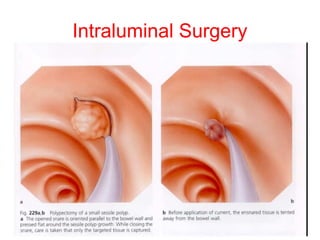 Intraluminal Surgery 
 