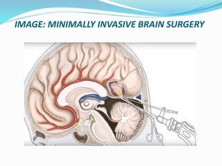 IMAGE: MINIMALLY INVASIVE BRAIN SURGERY
 