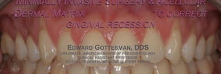 MINIMALLY INVASIVE SURGERY & ACELLULAR
DERMAL MATRIX TO CORRECT
GINGIVAL RECESSION
EDWARD GOTTESMAN, DDS
DIPLOMATE, AMERICAN BOARD OF PERIODONTOLOGY
CLINICAL ASSISTANT PROFESSOR,
SCHOOL OF DENTAL MEDICINE @ STONY BROOK
 