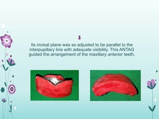 Its incisal plane was so adjusted to be parallel to the
interpupillary line with adequate visibility. This ANTAG
guided th...