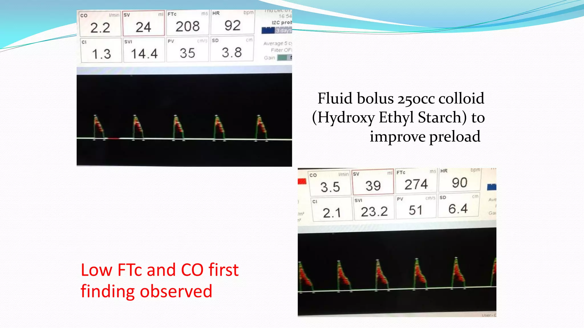 Preload Fluids Minimaly invasive hemodynamic monitoring for hepatic patients | PDF