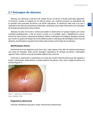 PROCEDIMENTOS



2.1 Drenagem de abscesso

   Abscesso, por definição, constitui-se de coleção de pus na derme e tecidos profundos adjacentes.
O furúnculo consiste na infecção de um folículo piloso, com material purulento se estendendo até
as camadas mais profundas de derme e do tecido subcutâneo. O carbúnculo nada mais é do que a
                                                                                                          15
coalescência dos folículos severamente inflamados, resultando numa massa inflamatória com drenagem
de secreção purulenta pelos vários orifícios.

   Abscessos de pele, furúnculos e carbúnculos podem se desenvolver em pessoas hígidas, sem outras
condições predisponentes, a não ser portar na pele ou na cavidade nasal o Staphylococcus aureus.
Fatores de riscos incluem a presença de Diabetes mellitus e alterações imunológicas. Qualquer processo
que resulta na quebra de solução de continuidade da pele ou alterações dermatológicas como traumas
abrasivos, escarificações ou picaduras de insetos pode resultar na formação de um abscesso.

   Manifestações clínicas

   Geralmente há sinais flogísticos locais como calor, rubor, edema e dor, além de nódulos eritematosos
com sinais de flutuação. Pode ocorrer drenagem espontânea de secreção purulenta e adenopatia
regional. Febre, calafrios, sinais de toxicidade sistêmica são incomuns.

    Furúnculos e carbúnculos se apresentam em áreas que contêm folículos pilosos que são expostos à
fricção e perspiração, destacando-se a porção posterior do pescoço, face, axila e região da barba, nos
homens (Figuras 1)




Figura 1 – Abscesso em membro inferior.
Fonte: (GOOGLE, 2010).


   Diagnósticos diferenciais

   Foliculite, hidradenite supurativa, miíase, leishmaniose, blastomicose.
 
