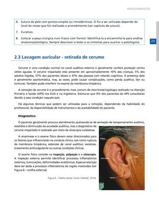 PROCEDIMENTOS



 6. Sutura da pele com pontos simples ou intradérmicos. O fio a ser utilizado depende do
    local do corpo que foi realizado o procedimento (ver capítulo de sutura).

 7. Curativo.

 8. Colocar a peça cirúrgica num frasco com formol. Identificá-la e encaminhá-la para análise
    anatomopatológica. Sempre descrever a lesão e os sintomas para auxiliar o patologista.           23



2.3 Lavagem auricular - retirada de cerume

    Cerume é uma condição normal no canal auditivo externo e geralmente confere proteção contra
otites agudas. O cerume impactado está presente em aproximadamente 10% das crianças, 5% dos
adultos hígidos, 57% dos pacientes idosos e 37% das pessoas com retardo cognitivo. A presença dele
é geralmente assintomática, mas, às vezes, pode causar complicações, como perda auditiva, dor ou
tonturas. Também pode interferir no exame da membrana timpânica.

   A remoção de cerume é o procedimento mais comum de otorrinolaringologia realizado na Atenção
Primária à Saúde (APS) nos EUA e na Inglaterra. Estima-se que 4% dos pacientes da APS consultarão
devido a essa condição naquele país.

   Há algumas técnicas que podem ser utilizadas para a remoção, dependendo da habilidade do
profissional, da disponibilidade de instrumentos e da aceitabilidade do paciente.

   Diagnóstico

   O paciente geralmente procura atendimento queixando-se de sensação de tamponamento auditivo,
estalidos e diminuição da acuidade auditiva, mas o diagnóstico de
cerume impactado é realizado por meio da otoscopia cuidadosa.

    A anamnese e o exame físico devem estar direcionados para
os fatores que influenciarão na conduta clínica, tais como ruptura
de membrana timpânica, estenose de canal auditivo, exostose,
tratamento anticoagulante ou outras condições clínicas.

   O exame físico consiste na inspeção, palpação e a otoscopia.
A inspeção externa permite identificar processos inflamatórios
externos, tumorações, deformidades anatômicas. Especial atenção
deve ser dada a processos inflamatórios da região mastoidea (ver
Figura 6 – orelha externa).

                          Figura 6 – Orelha direita. Fonte: (SAGAZ, 2010).
 
