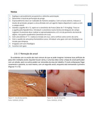 PROCEDIMENTOS



   Técnica

 1. Explique o procedimento ao paciente e obtenha autorização.
 2. Determine o local da perfuração do prego.
 3. O procedimento deve ser realizado de maneira asséptica. Com as luvas estéreis, máscara e
    óculos de proteção, prepare a área afetada com um agente tópico disponível e cubra-a com
                                                                                                        35
    o campo estéril.
 4. Usando a agulha 40 x 12, aspira-se o anestésico do frasco (dose de 7-10 mg/kg). Troca-se
    a agulha pela hipodérmica. Introduzir o anestésico numa técnica de bloqueio de campo
    regional. A anestesia deve realizar-se aproximadamente a 0,5 cm do perímetro do local do
    objeto, nos quatro quadrantes (anestesia em cruz).
 5. Com uma lâmina nº 11, realiza-se incisão em cruz, com o orifício como centro do corte.
 6. Com o auxílio de uma pinça hemostática curva, introduzir uma gaze com soro fisiológico na
    incisão para limpeza.
 7. Irrigação com soro fisiológico
 8. Curativo com gaze.



         2.5.1.7 Remoção de anzol
    Os acidentes com os anzóis são mais comuns do que se pode imaginar. Inúmeras iscas artificiais de
pesca têm múltiplos anzóis. Quando houver vários, é uma boa ideia cortar a farpa do anzol perfurador
com um alicate, assim os outros podem ser removidos da área de trabalho. É muito embaraçoso fisgar
novamente o paciente, ou você mesmo, com um segundo anzol, enquanto está removendo o primeiro
(Figuras 11 e 12).




Figura 11 – Isca de duas pontas.                   Figura 12 – Isca de três pontas.
Fonte: (GOOGLE, [2010]).                           Fonte: (GOOGLE, 2010]).
 