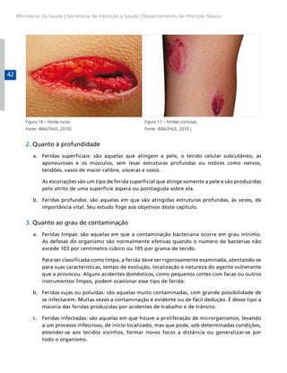Ministério da Saúde | Secretaria de Atenção a Saúde | Departamento de Atenção Básica




42




         Figura 16 – Ferida incisa.                         Figura 17 – Feridas contusas.
         Fonte: (MALTHUS, 2010).                            Fonte: (MALTHUS, 2010.)


         2. Quanto à profundidade
             a. Feridas superficiais: são aquelas que atingem a pele, o tecido celular subcutâneo, as
                aponeuroses e os músculos, sem lesar estruturas profundas ou nobres como nervos,
                tendões, vasos de maior calibre, vísceras e ossos.

                  As escoriações são um tipo de ferida superficial que atinge somente a pele e são produzidas
                  pelo atrito de uma superfície áspera ou pontiaguda sobre ela.

             b. Feridas profundas: são aquelas em que são atingidas estruturas profundas, às vezes, de
                importância vital. Seu estudo foge aos objetivos deste capítulo.


         3. Quanto ao grau de contaminação
             a. Feridas limpas: são aquelas em que a contaminação bacteriana ocorre em grau mínimo.
                As defesas do organismo são normalmente efetivas quando o número de bactérias não
                excede 103 por centímetro cúbico ou 105 por grama de tecido.

                  Para ser classificada como limpa, a ferida deve ser rigorosamente examinada, atentando-se
                  para suas características, tempo de evolução, localização e natureza do agente vulnerante
                  que a provocou. Alguns acidentes domésticos, como pequenos cortes com facas ou outros
                  instrumentos limpos, podem ocasionar esse tipo de ferida.

             b. Feridas sujas ou poluídas: são aquelas muito contaminadas, com grande possibilidade de
                se infectarem. Muitas vezes a contaminação é evidente ou de fácil dedução. É desse tipo a
                maioria das feridas produzidas por acidentes de trabalho e de trânsito.

             c.   Feridas infectadas: são aquelas em que houve a proliferação de microrganismos, levando
                  a um processo infeccioso, de início localizado, mas que pode, sob determinadas condições,
                  estender-se aos tecidos vizinhos, formar novos focos a distância ou generalizar-se por
                  todo o organismo.
 