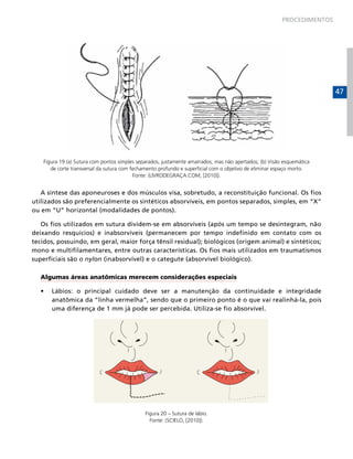 PROCEDIMENTOS




                                                                                                                         47




    Figura 19 (a) Sutura com pontos simples separados, justamente amarrados, mas não apertados; (b) Visão esquemática
       de corte transversal da sutura com fechamento profundo e superficial com o objetivo de eliminar espaço morto.
                                           Fonte: (LIVRODEGRAÇA.COM, [2010]).


   A síntese das aponeuroses e dos músculos visa, sobretudo, a reconstituição funcional. Os fios
utilizados são preferencialmente os sintéticos absorvíveis, em pontos separados, simples, em “X”
ou em “U” horizontal (modalidades de pontos).

   Os fios utilizados em sutura dividem-se em absorvíveis (após um tempo se desintegram, não
deixando resquícios) e inabsorvíveis (permanecem por tempo indefinido em contato com os
tecidos, possuindo, em geral, maior força tênsil residual); biológicos (origem animal) e sintéticos;
mono e multifilamentares, entre outras características. Os fios mais utilizados em traumatismos
superficiais são o nylon (inabsorvível) e o categute (absorvível biológico).

   Algumas áreas anatômicas merecem considerações especiais

   •	   Lábios: o principal cuidado deve ser a manutenção da continuidade e integridade
        anatômica da “linha vermelha”, sendo que o primeiro ponto é o que vai realinhá-la, pois
        uma diferença de 1 mm já pode ser percebida. Utiliza-se fio absorvível.




                                               Figura 20 – Sutura de lábio.
                                                 Fonte: (SCIELO, [2010]).
 
