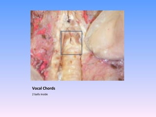 Vocal Chords 2 balls inside  