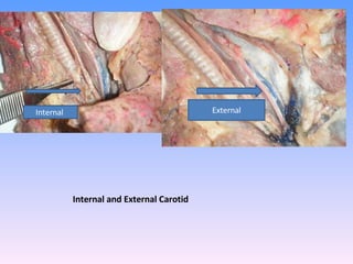 Internal and External Carotid Internal  External 