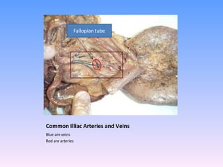 Common Illiac Arteries and Veins Blue are veins  Red are arteries  Fallopian tube 