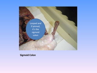 Sigmoid Colon  Looped and if pinned, it’s the sigmoid colon 