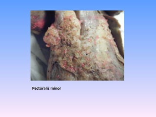 Pectoralis minor 