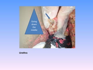 Urethra Going down the middle 