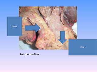 Both pectoralises  Major Minor 