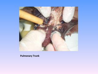Pulmonary Trunk 