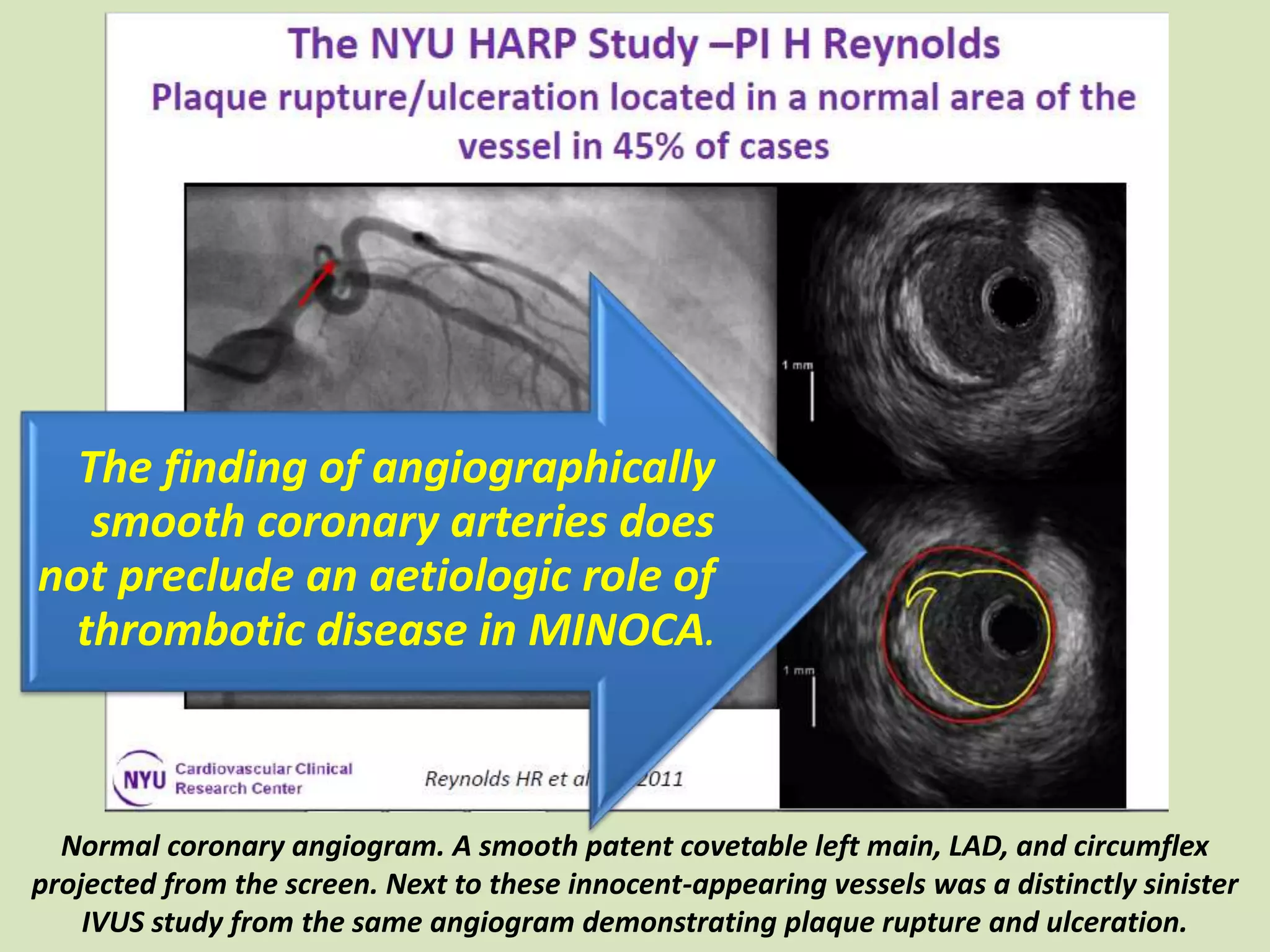 Normal coronary angiogram. A smooth patent covetable left main, LAD, and circumflex
projected from the screen. Next to these innocent-appearing vessels was a distinctly sinister
IVUS study from the same angiogram demonstrating plaque rupture and ulceration.
The finding of angiographically
smooth coronary arteries does
not preclude an aetiologic role of
thrombotic disease in MINOCA.
 